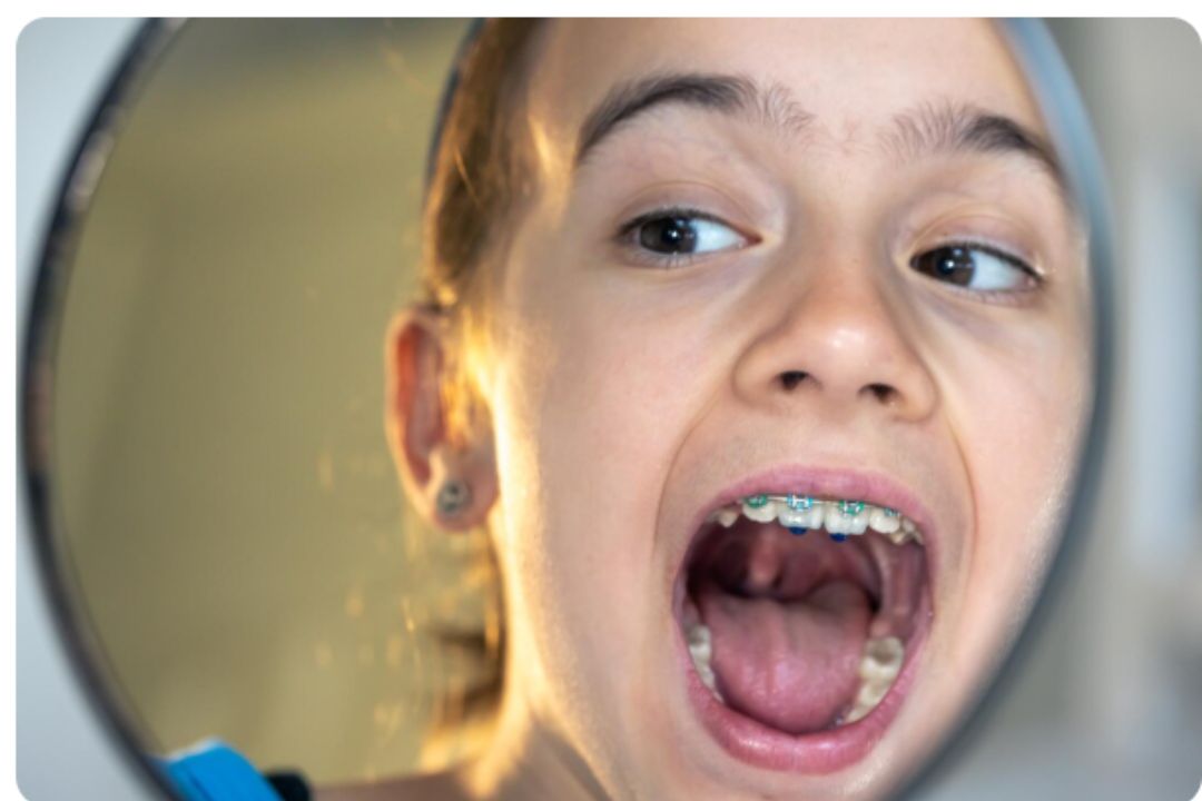 do braces permanently damage your teeth